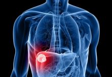 أعراض التهاب